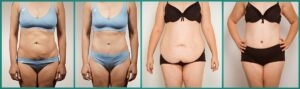 L’abdominoplastie en Turquie – une bonne idée même à un âge avancé