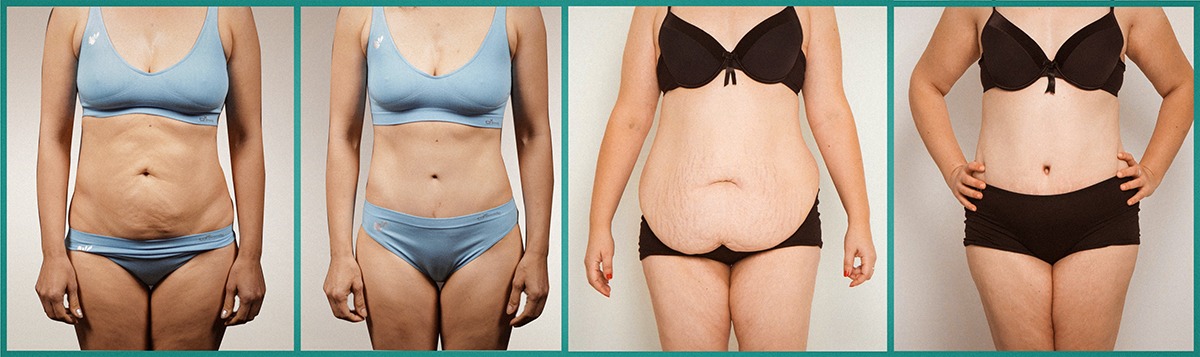 L’abdominoplastie en Turquie – une bonne idée même à un âge avancé