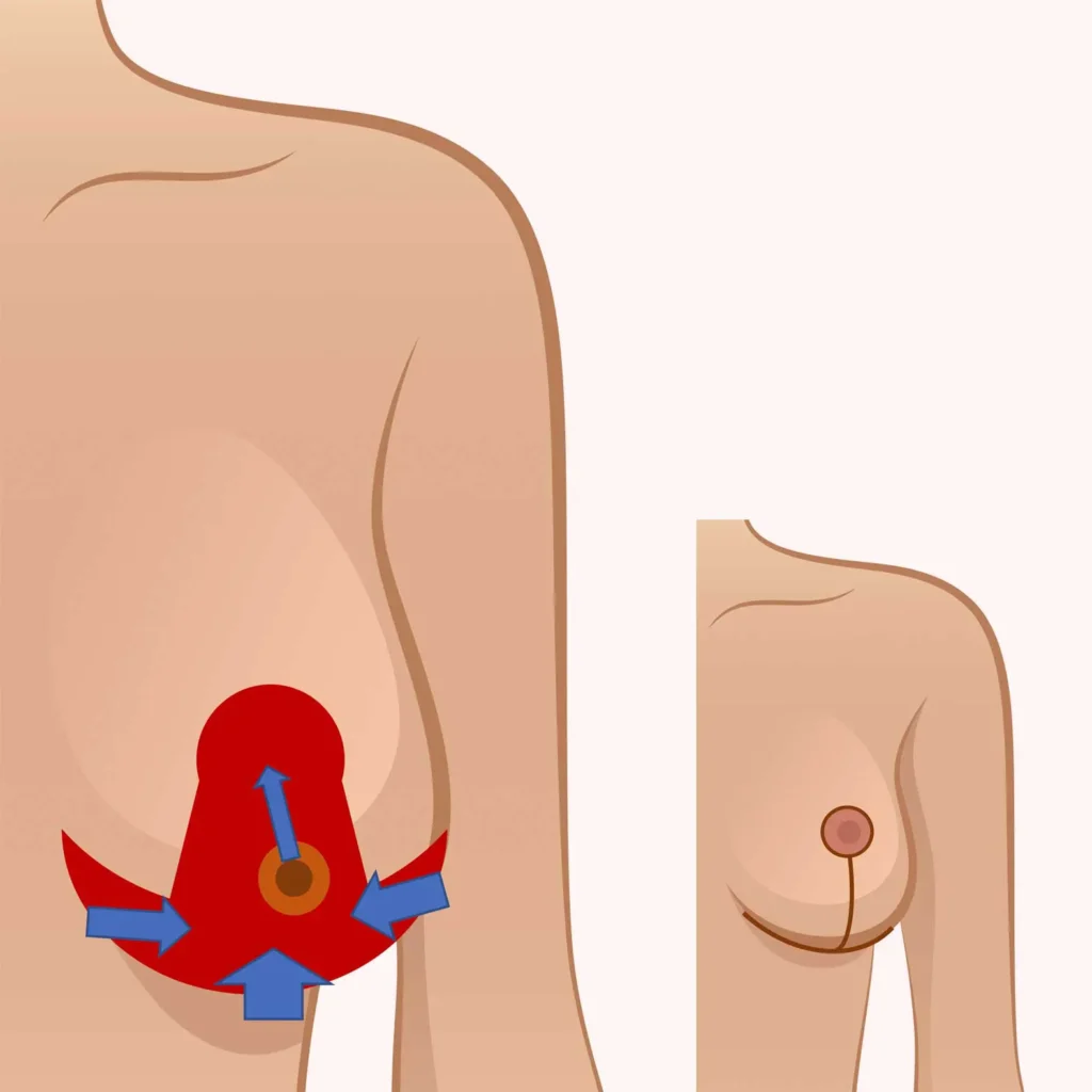 Les questions les plus fréquemment posées sur le lifting des seins