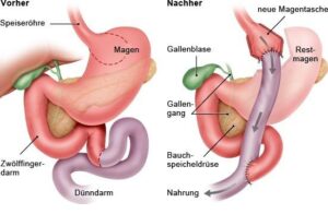 Troubles après un bypass gastrique