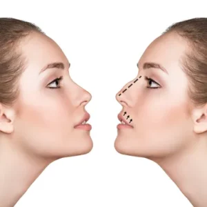 Après une rhinoplastie en Turquie, vous êtes à nouveau en avance