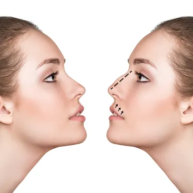Après une rhinoplastie en Turquie, vous êtes à nouveau en avance