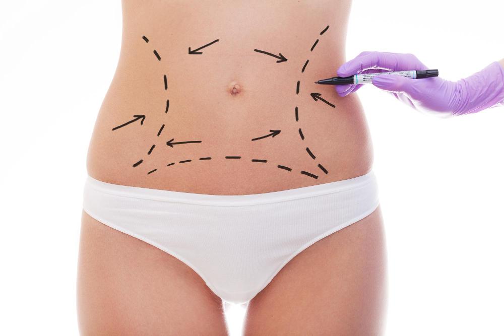 Liposuccion