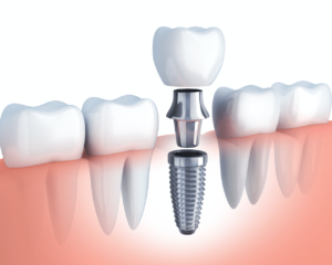Implants dentaires en Turquie à Antalya