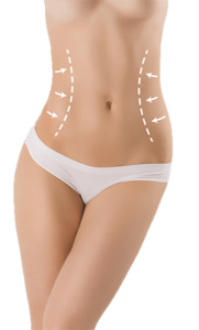 L’abdominoplastie coûts en Turquie – avantages et déroulement