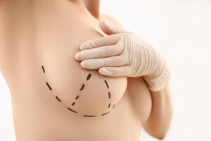 Lifting des seins en Turquie – Est-ce sûr ?