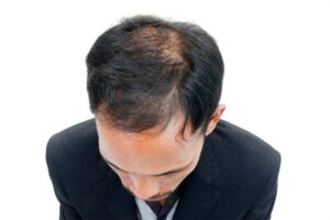 Les causes les plus fréquentes de la chute des cheveux