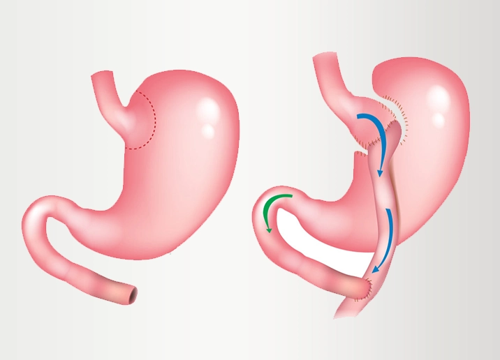 Bypass Gastrique
