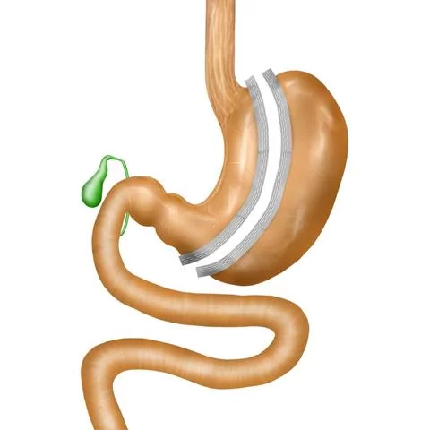 Chirurgie bariatrique