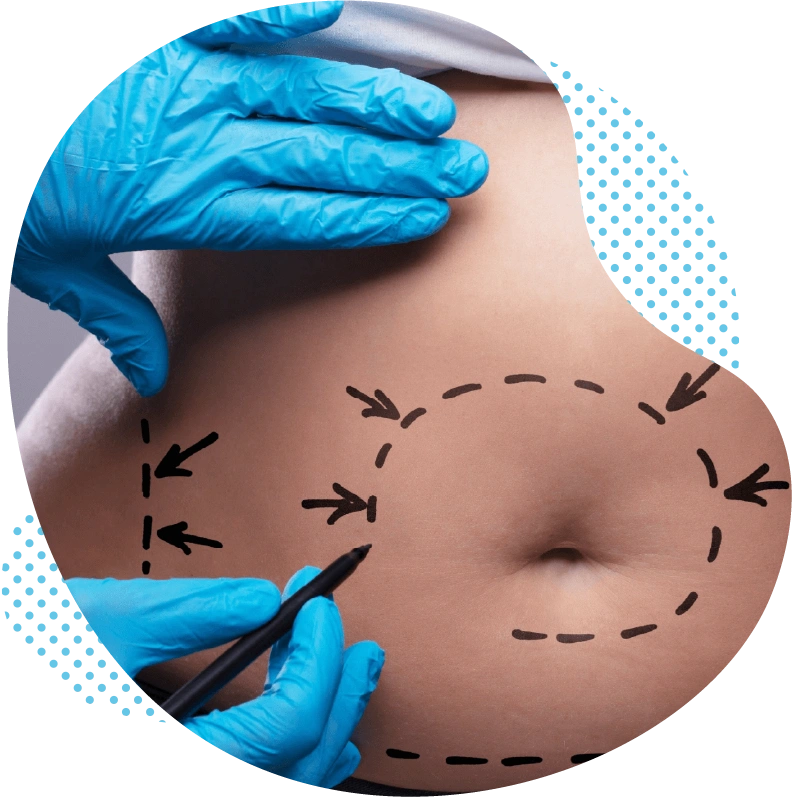 L’abdominoplastie