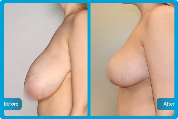 Before After