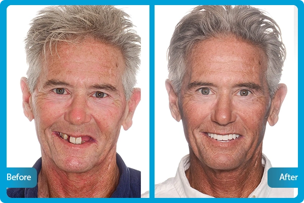 Before After