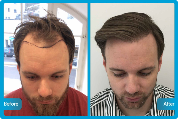 Before After