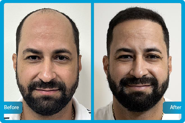 Before After