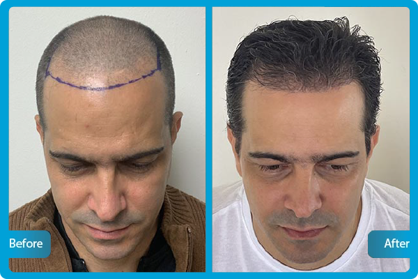 Before After