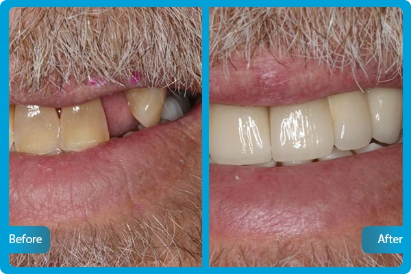 Before After