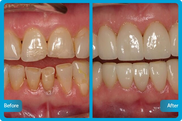 Before After