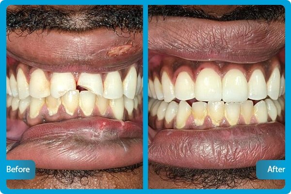 Before After