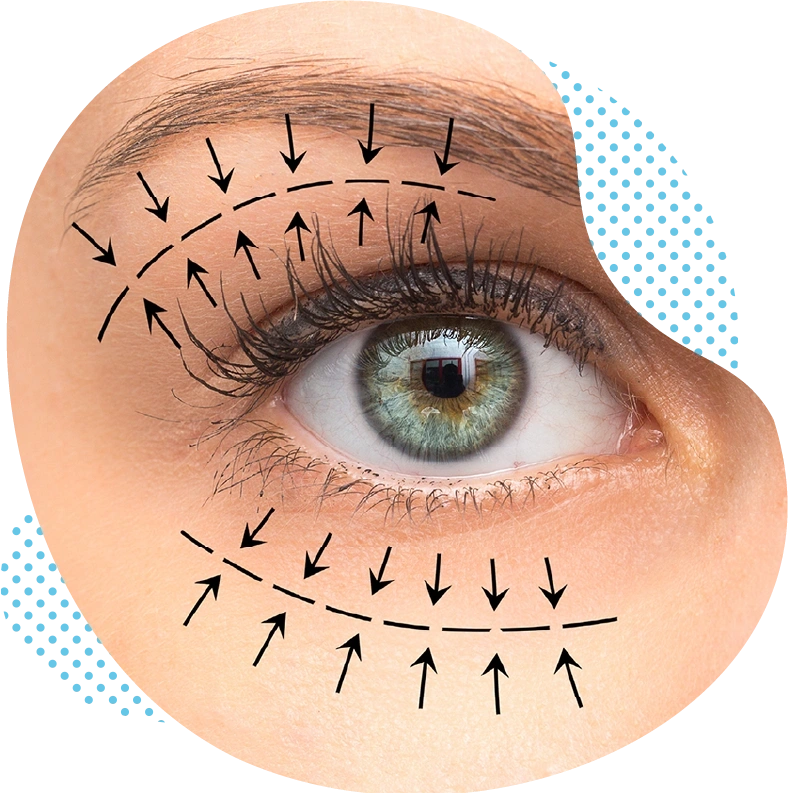 Des poches sous les yeux, cernes et paupières tombantes – que pouvez-vous faire ?