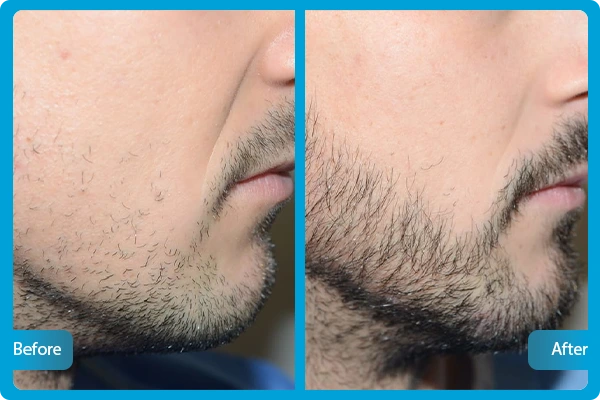 Before After