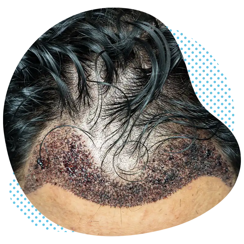 Pourquoi une greffe de cheveux par DHI ?