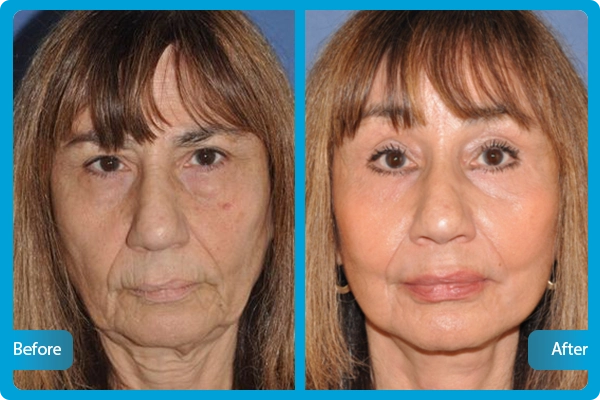 Before After