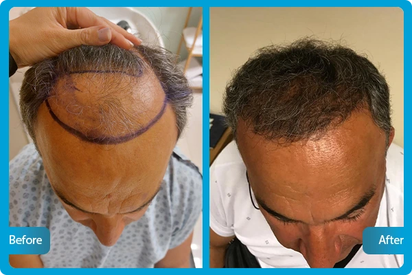 Before After