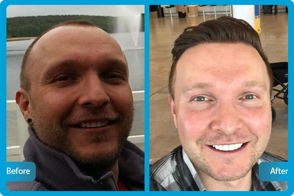 Before After