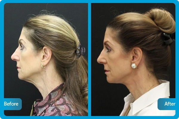 Before After