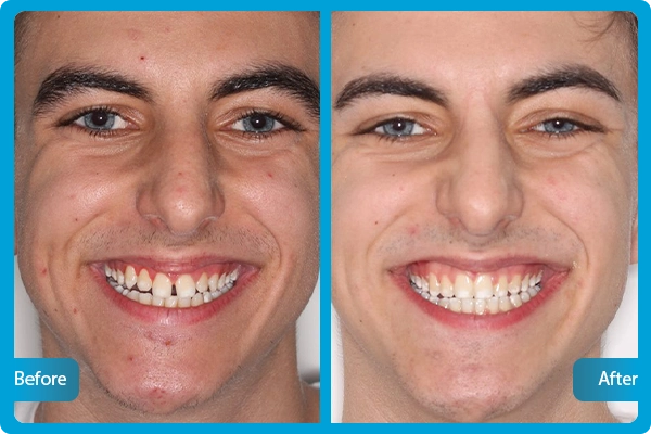 Before After