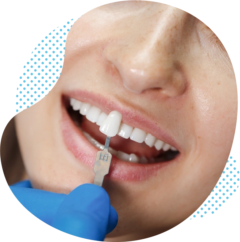 Les facettes dentaires en Turquie – De belles dents sans ponçage